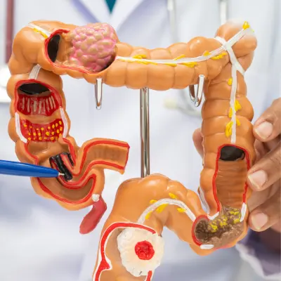 atención a colon en oaxaca