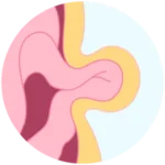 hernias