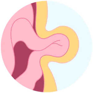 hernias