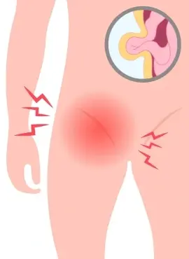 Cirugía de Hernia Inguinal en Oaxaca 