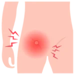 Cirugía de Hernia en Oaxaca