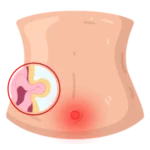 Cirugía de Hernia en Oaxaca