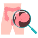 Cirugía de Hernia en Oaxaca